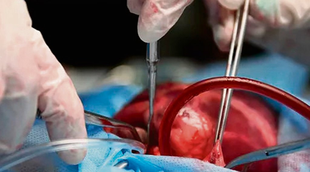 Hospital Lauro Reus realiza primeira captação múltipla de órgãos para transplante 1 Hospital Lauro Reus realiza primeira captação múltipla de órgãos para transplante