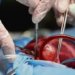 Hospital Lauro Reus realiza primeira captação múltipla de órgãos para transplante 6 Hospital Lauro Reus realiza primeira captação múltipla de órgãos para transplante