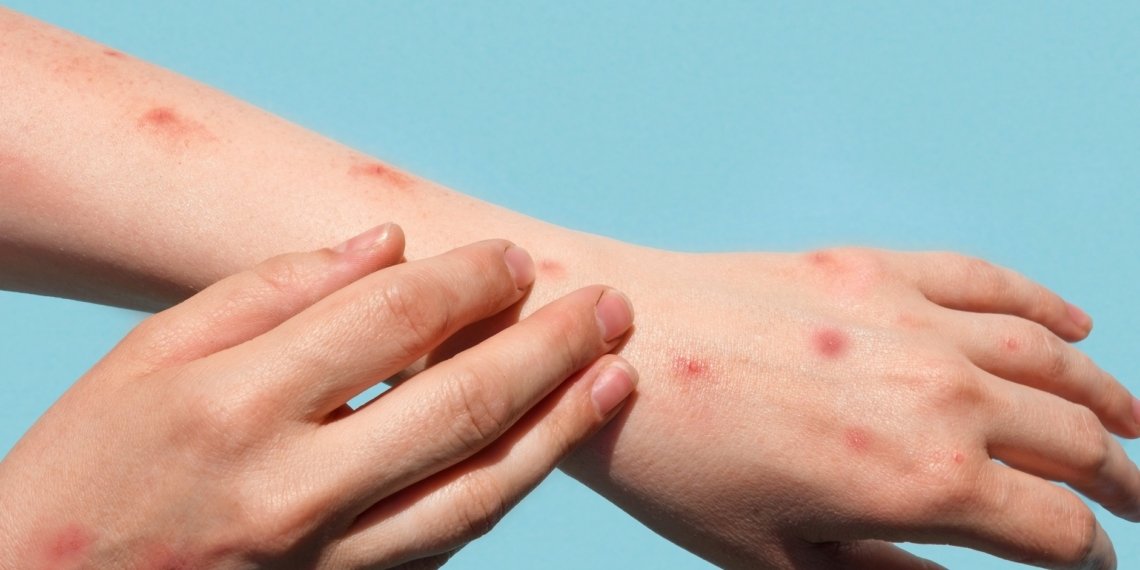 Campo Bom confirma primeiro caso de Varíola dos Macacos e Secretaria Municipal de Saúde monitora o quadro 1 Campo Bom confirma primeiro caso de Varíola dos Macacos e Secretaria Municipal de Saúde monitora o quadro