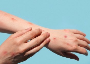 Campo Bom confirma primeiro caso de Varíola dos Macacos e Secretaria Municipal de Saúde monitora o quadro