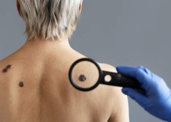 Com inverno atípico, Secretaria de Saúde alerta para os cuidados contra o câncer de pele