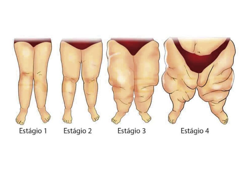 Lipedema: a luta silenciosa de milhares de mulheres