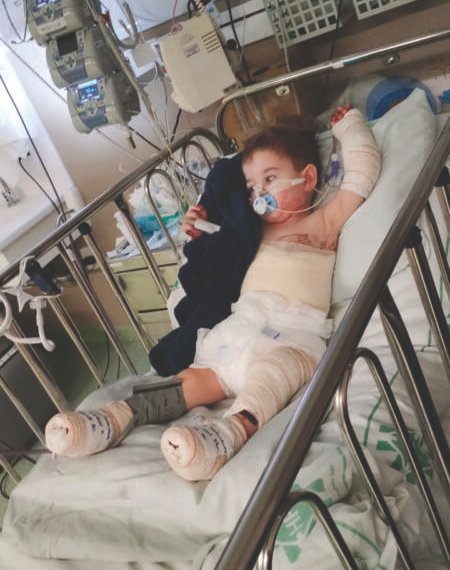 Acidente doméstico mobiliza comunidade em apoio ao pequeno João Vitor 1 Acidente doméstico mobiliza comunidade em apoio ao pequeno João Vitor