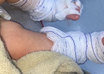 Criança que sofreu queimaduras segue internada, família faz manifestação e hospital emite boletim médico
