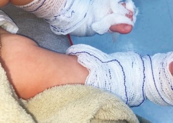 Polícia Civil aponta lesão culposa em caso de bebê que sofreu queimaduras durante banho em EMEI no município